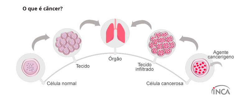 cancer: celula normal, tecido, gao, tecido infiltrado, celula cancerosa, agente cancerigeno